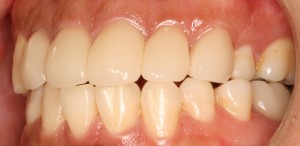 田村4　装着　左側面